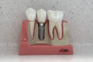 Replace a missing tooth with dental implants