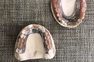 Dentures are a common solution for replacing teeth that have been lost or removed