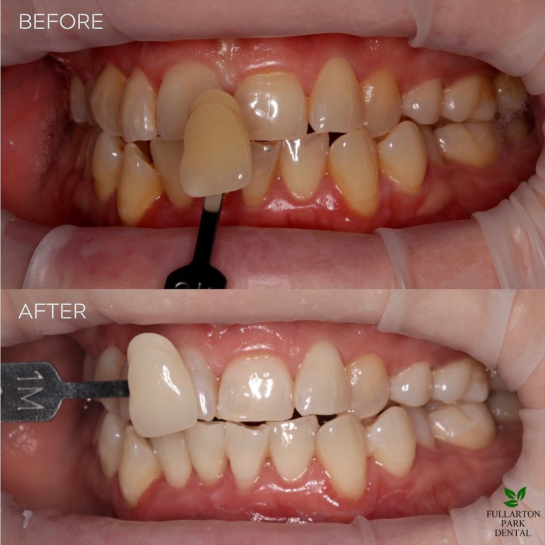 Before Vs After Teeth Whitening Treatment by our Oral Health Therapist Amy